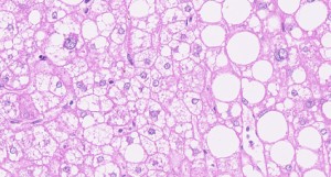 Haematoxylin/eosin (H/E) staining of a liver section derived from a human patient with NASH. Immune cell infiltrates, ballooning hepatocytes and fatty droplets are visible (courtesy of Professor Achim Weber).