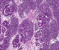 Wilms' tumour, a type of kideny cancer