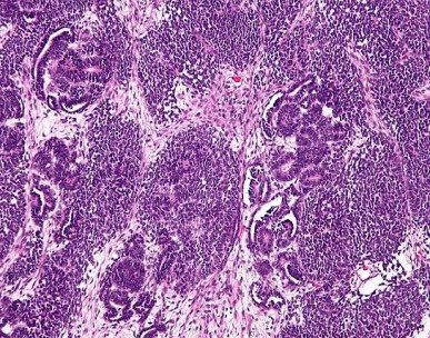 Wilms' tumour, a type of kideny cancer