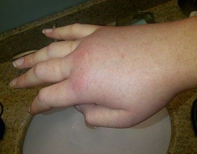 Swollen right hand during a hereditary angioedema attack