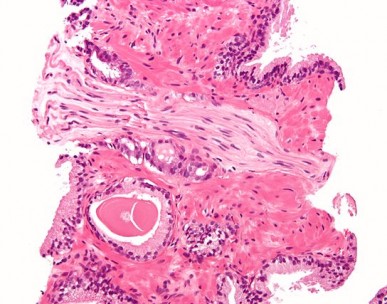 Micrograph showing a prostate cancer (conventional adenocarcinoma) with perineural invasion